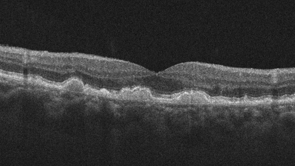 OCT scan showing dry AMD