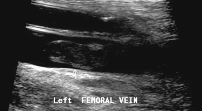 large blood clot 690&#215;380