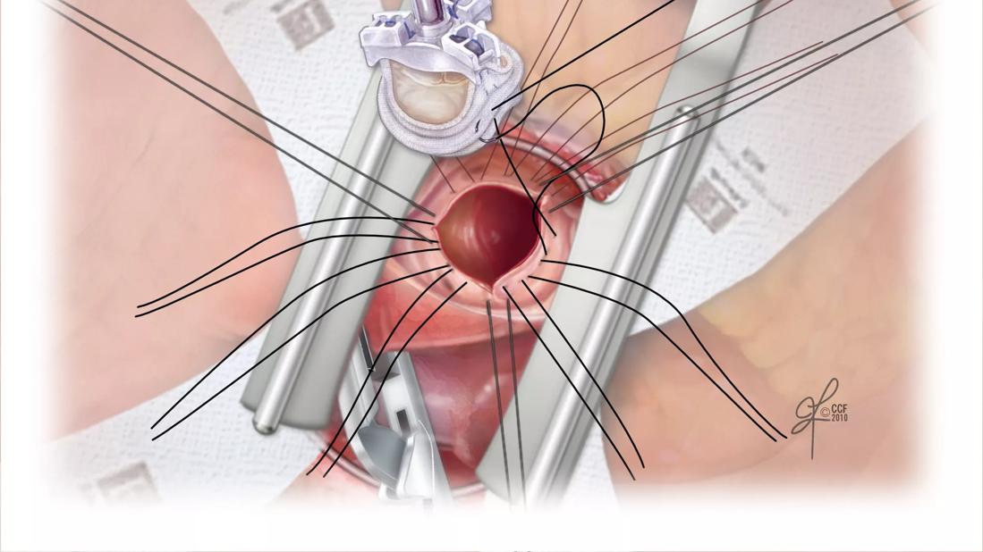 AVR-Prosthesis Suturing