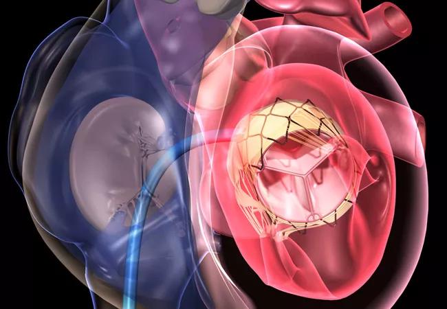 TAVR: A Key Option for Adults With Congenital Heart Disease