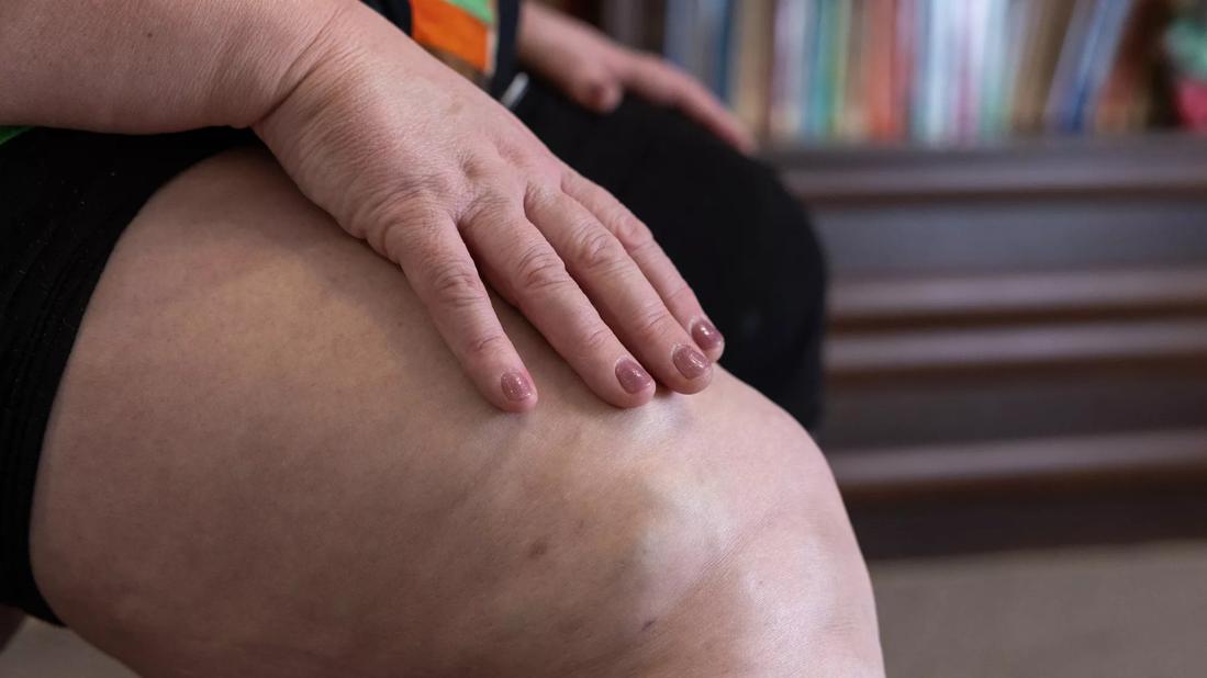 Knee of patient with obesity