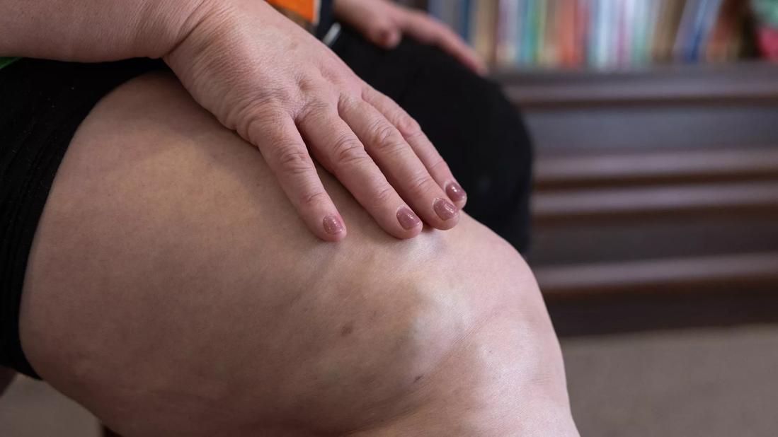 Knee of patient with obesity