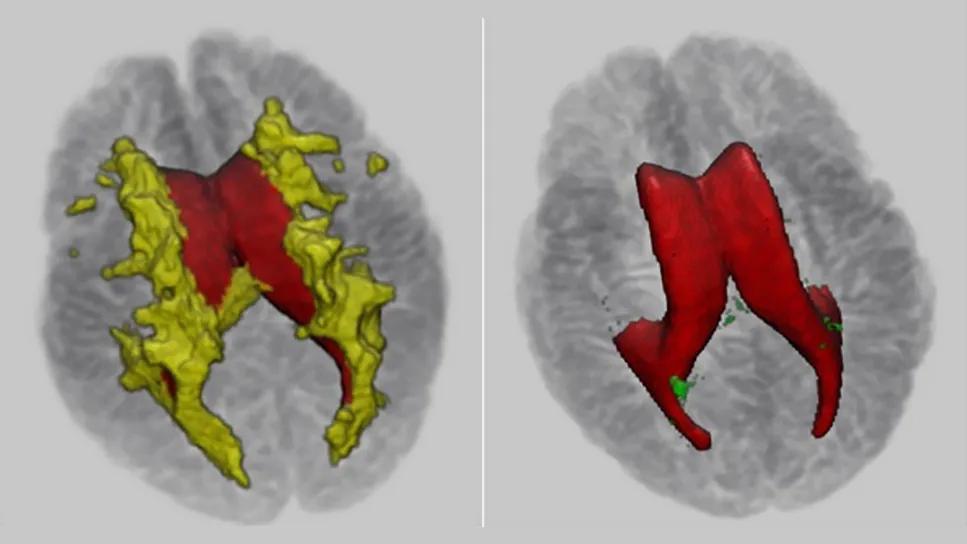 3D maps of T2 MRIs in postmortem multiple sclerosis brains