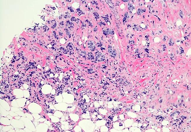 Mammary carcinoma with lobular features. Breast cancer