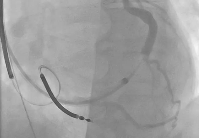 Nonresponse to CRT: A Case Study in Systematic Troubleshooting