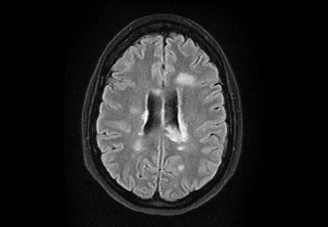 17-NEU-4135-Hersh-Ontaneda-MS-MRI-650&#215;450