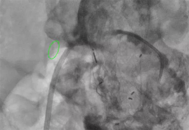 imaging study of type II endoleak