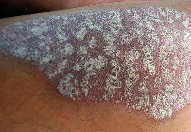 Psoriasis rash