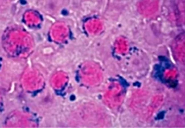 18-NEU-765-Sideroblastic-Anemia-650&#215;450