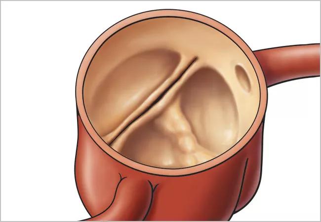 22-HVI-3030688_bicuspid-aortic-valve_650x450