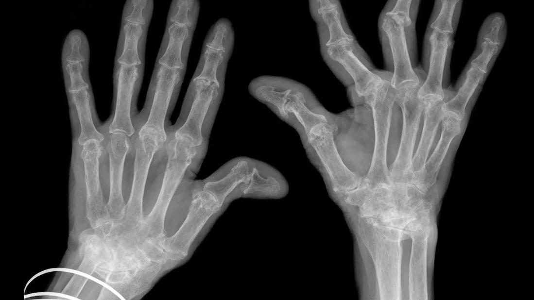 Arthritis