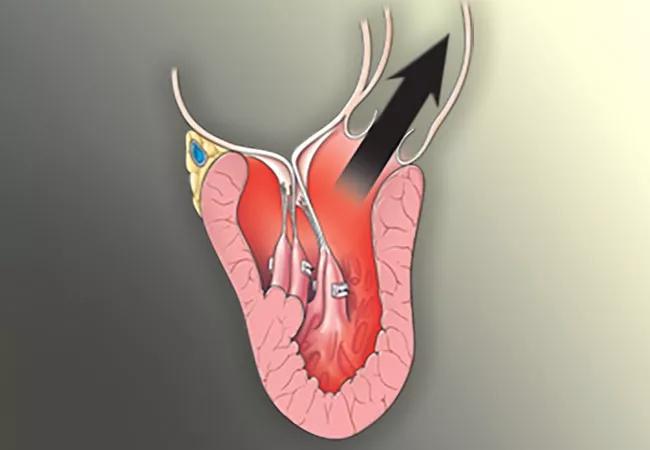 21-HVI-2577809_septal-myectomy-LVOTO-repair_650x450