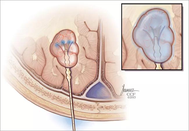 18-NEU-618-Vogelbaum-Brain-Tumor-650&#215;450