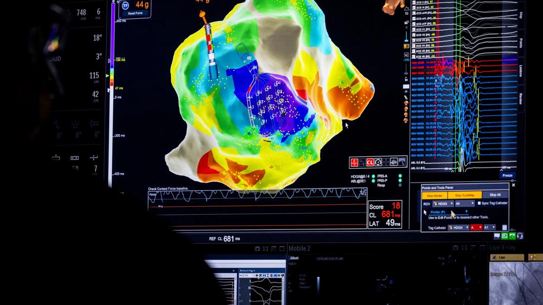 20-HVI-1885877-bailout-ventricular-ablation-650&#215;450