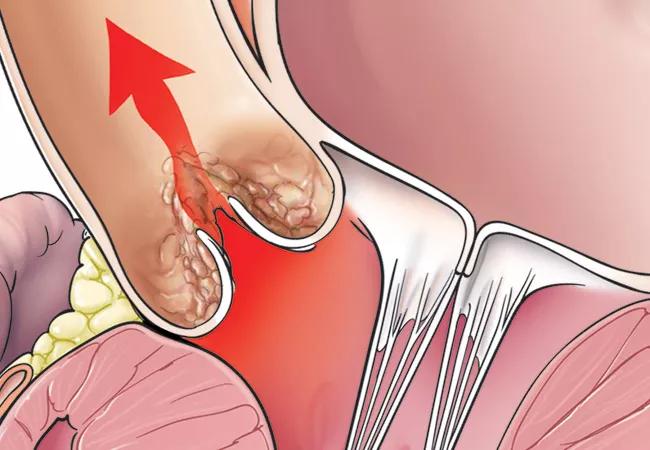 stenosed aortic valve within the heart