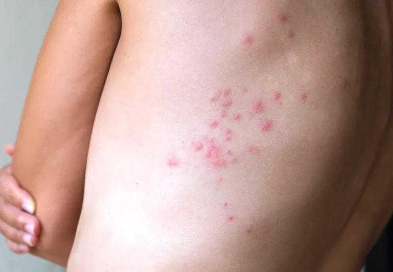 Close-up of red bed bug bites on a person's back