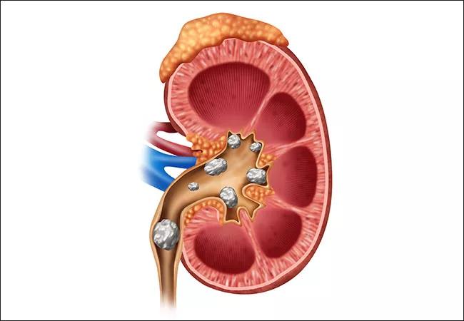 650&#215;450-Calle-Kidney-Stones