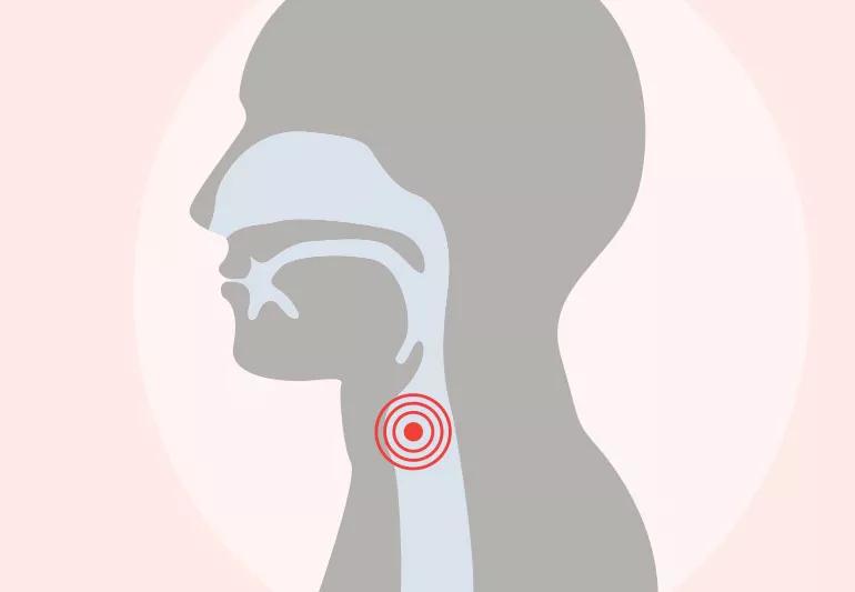 illustration of area where throat cancer appears
