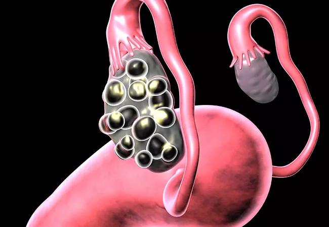 Bariatric Surgery May Help Women with Polycystic Ovarian Syndrome Overcome Infertility
