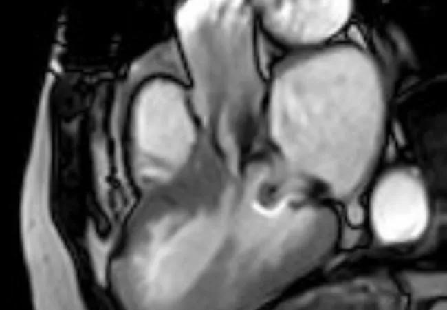 LV Outflow Tract Obstruction After Mitral Valve Replacement: Two Cases, Same Principles for Success