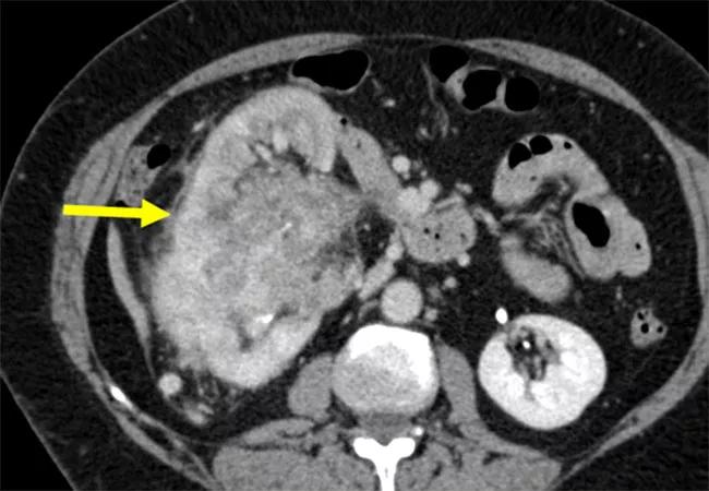 Infiltrative Renal Masses: More Common Than Previously Thought and Often Unrecognized
