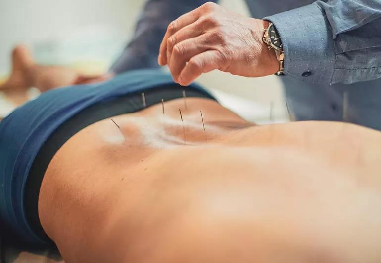 Person getting acupuncture in lower spine area for pain in back.