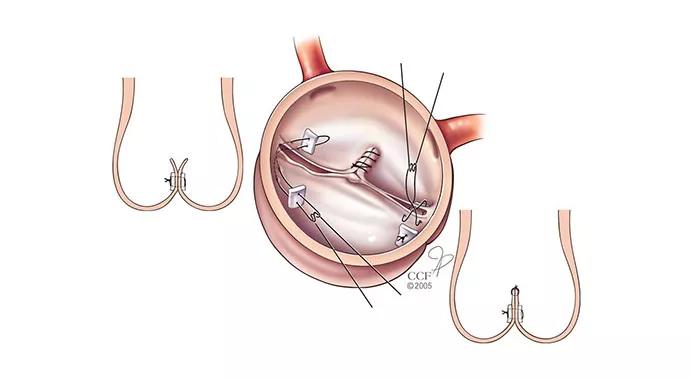 bicuspid_valve_repair_690x380