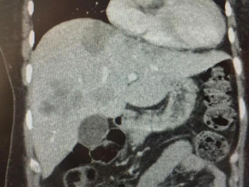 LiverTransProt-Fig-1