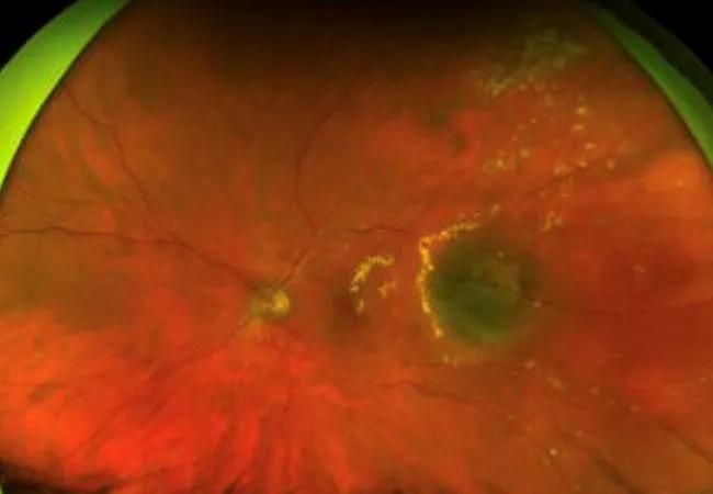 This color fundus photo of the clinical presentation of a left eye affected by radiation retinopathy shows multiple retinal exudates (yellow material) surrounding the irradiated tumor. Copyright image used with permission from Elsevir.