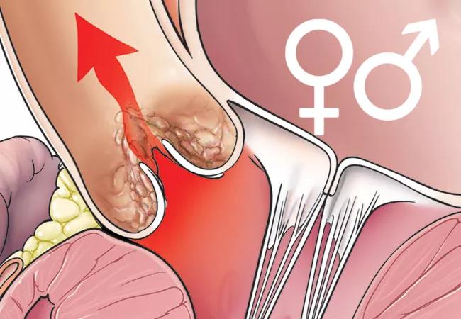 illustration of aortic stenosis suggesting sex-related differences