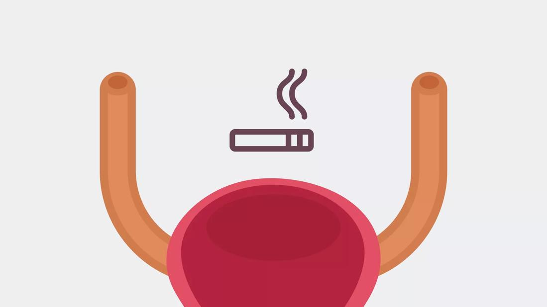 ‘Surprising Link’: Smoking and Bladder Cancer