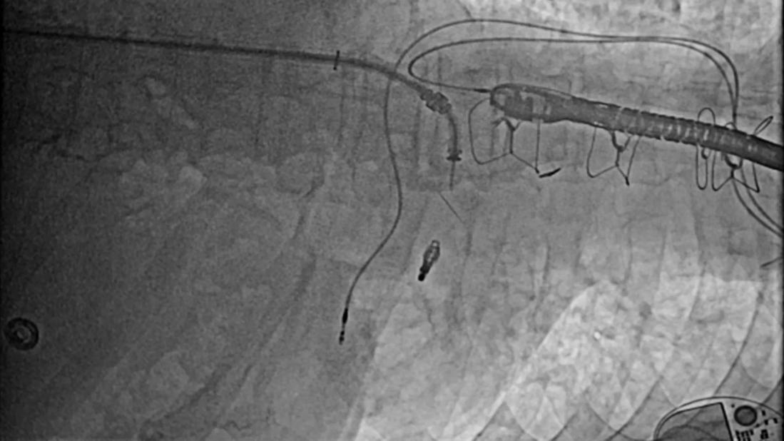 A transcatheter implanted clip improves coaptation of the mitral valve leaflets.