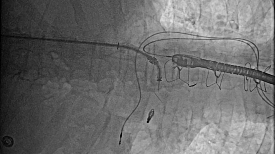 A transcatheter implanted clip improves coaptation of the mitral valve leaflets.