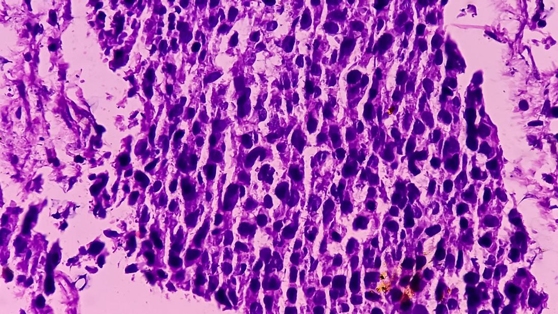 Microscopic view of bladder cancer with variant histology