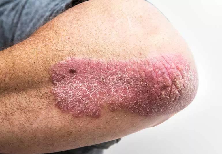 Psoriasis on elbow