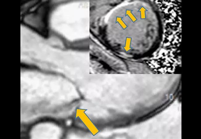 ischemic mitral regurgitation and a myocardial infarct