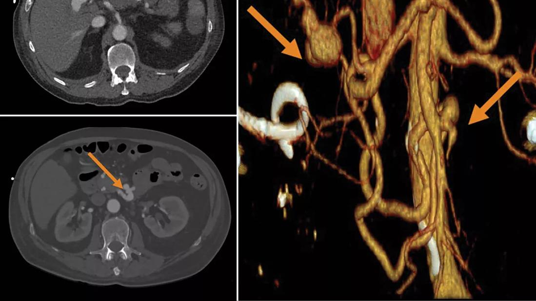 22-RHE-3091670-yaseen-endocarditis-CQD-jk