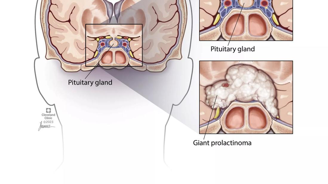 giant prolactinoma