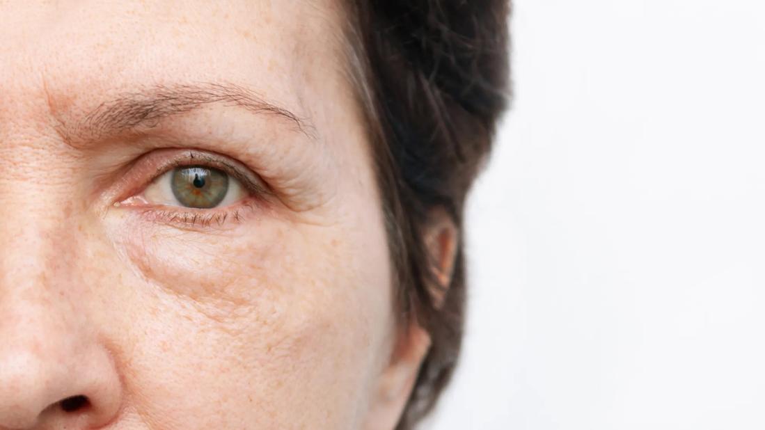 Close up of half a person's face with puffy under eye bag