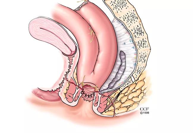 Common IPAA complications