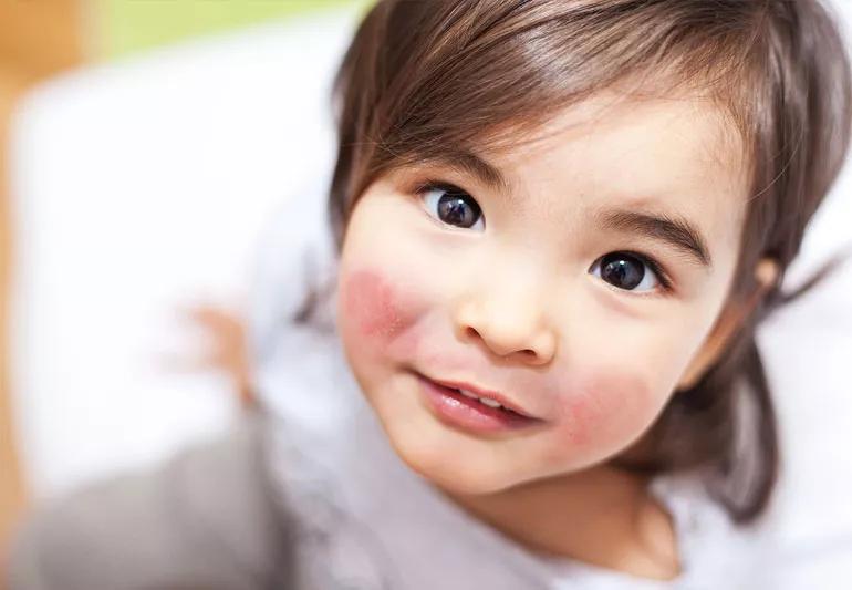 Little girl with chapped cheeks - fifth disease