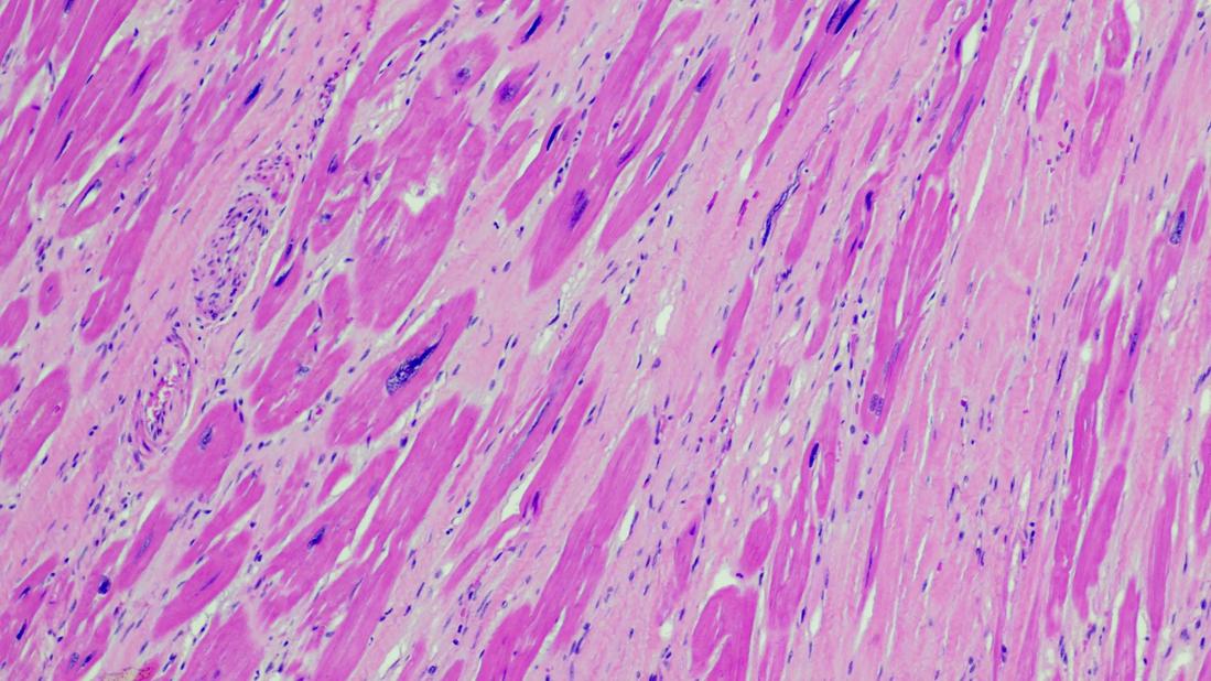 histopathologic image of tissue from a hypertrophied heart