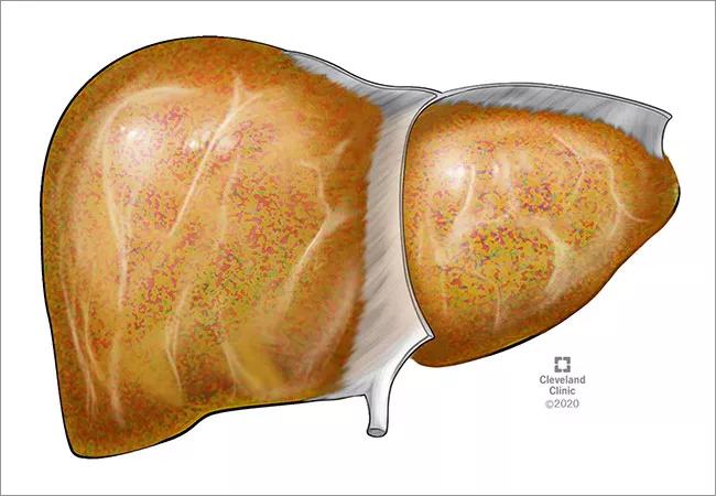 650&#215;450-Pediatric-Fatty-Liver