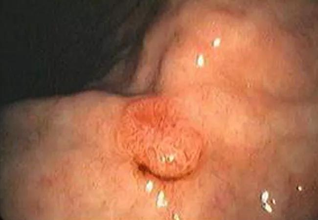 22-DDI-3242262 – Neuroendocrine Tumor-Kim-3-hero