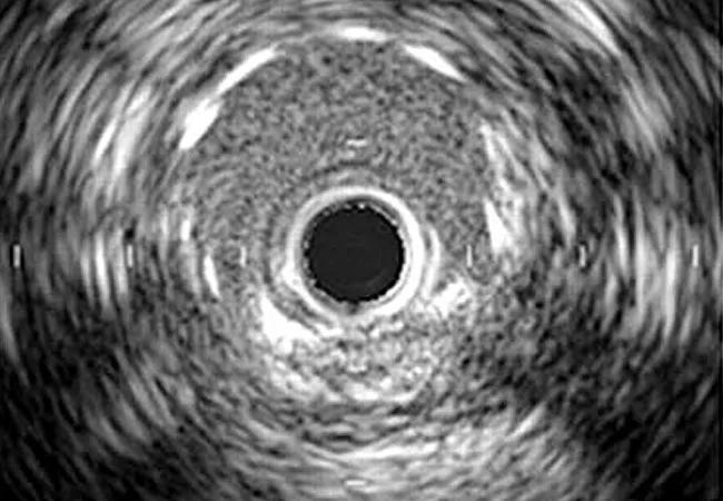 16-HRT-1304-IVUS-Guided-PCI-CQD-650&#215;450