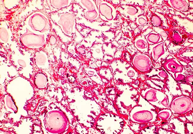 Photomicrograph of prostate hyperplasia