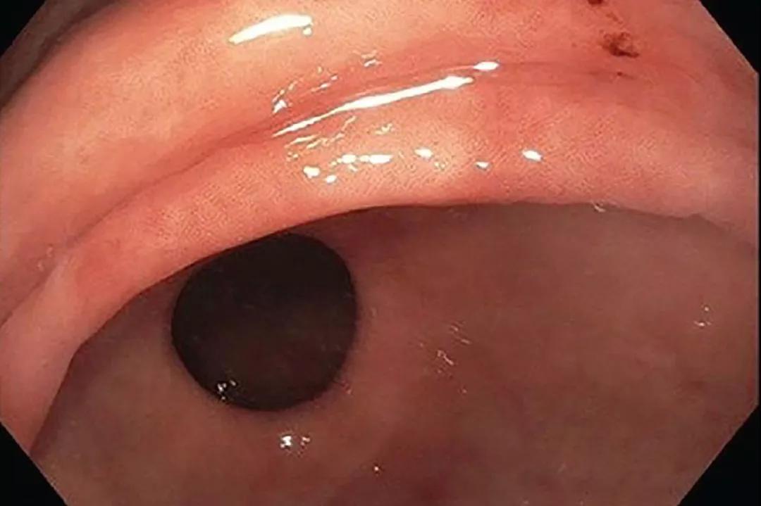 Endoscopic appearance of gastric intestinal metaplasia