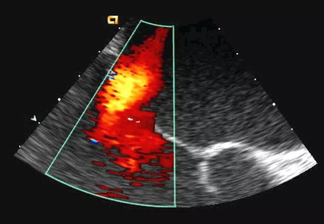 mitral valve prolapse