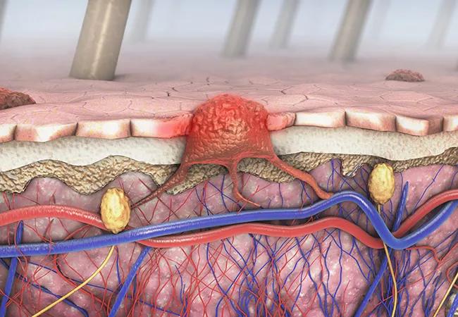 3d illustration of a cross-section of a diseased skin with melanoma that enters the bloodstream and lymphatic tract