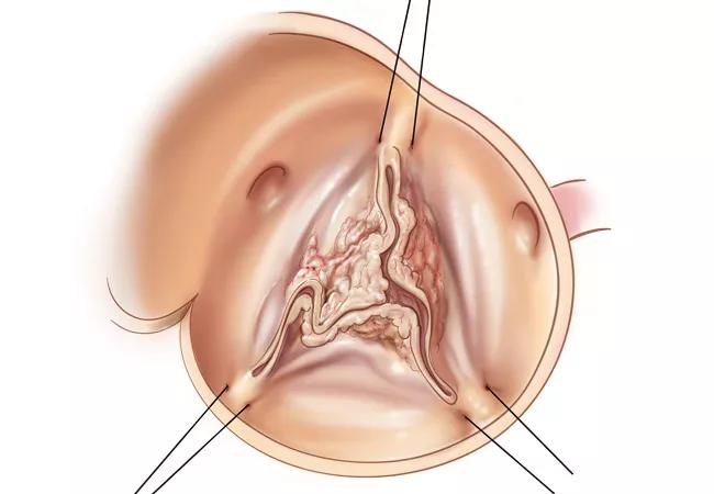 18-HRT-039-Endocarditis-CME-CQD